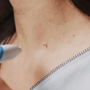 Applicateur d'élastiques pour acrochordons, outil de soin peau facile à utiliser à domicile.