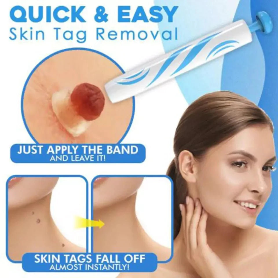 Éliminez vos acrochordons rapidement et sans douleur avec ce kit applicateur d'élastiques maison.